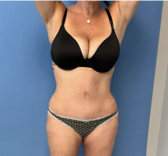 Tummy-Tuck-with-Liposuction--Case-Study-7031 | After Liposuction
